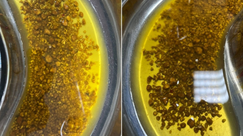 Doktorlar bile şaşırdı: Safra kesesinden 2 bin 67 taş çıktı